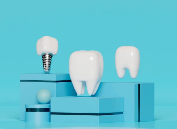 Les 5 questions les plus fréquentes sur les implants dentaires